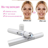 Blue Light Therapy Acne Laser